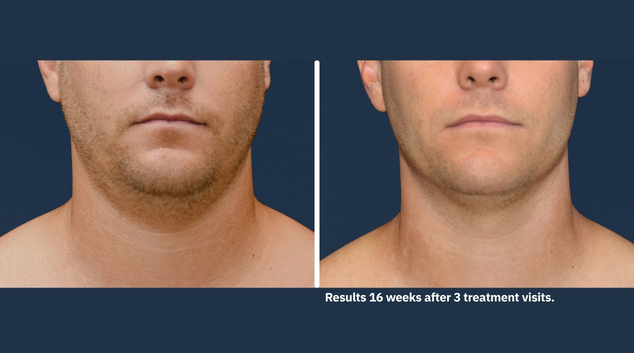 CoolSculpting Elite Double Chin Under the Neck results